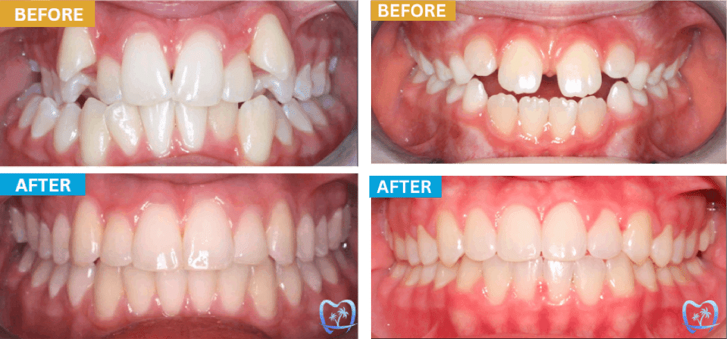 orthodontist-lake-forest-before-after