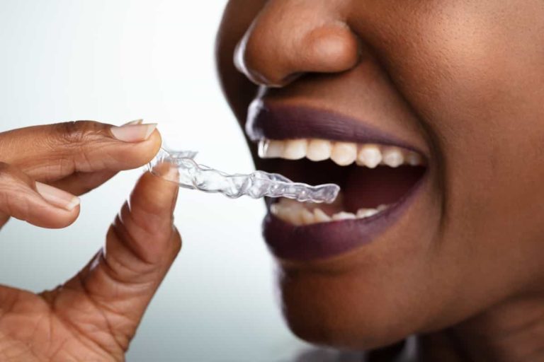 Smile Direct Club Downfall: What Happened to At-Home Aligners